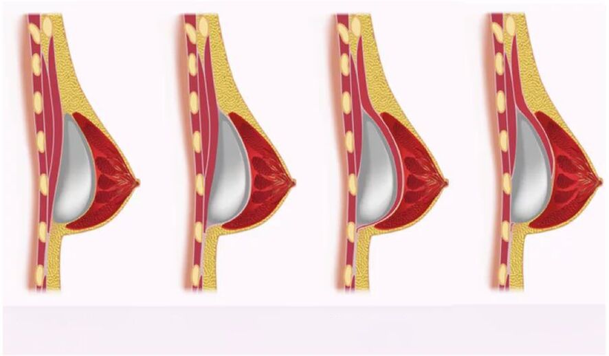 galimybė įdiegti implantus